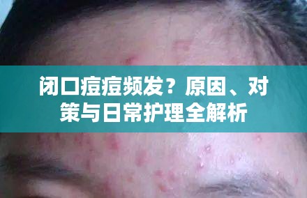 闭口痘痘频发？原因、对策与日常护理全解析