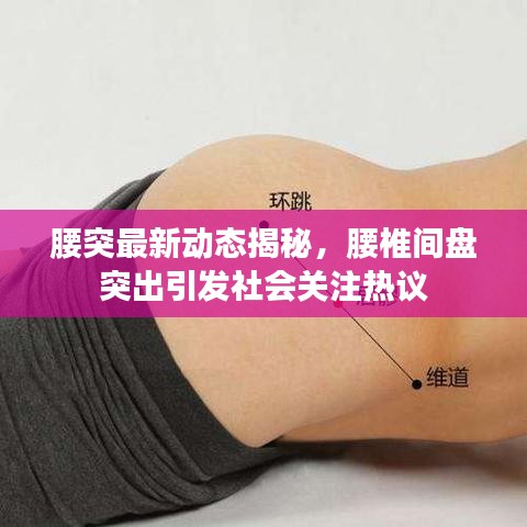 腰突最新动态揭秘，腰椎间盘突出引发社会关注热议