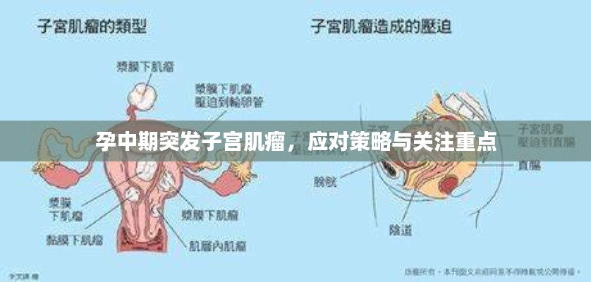孕中期突发子宫肌瘤，应对策略与关注重点